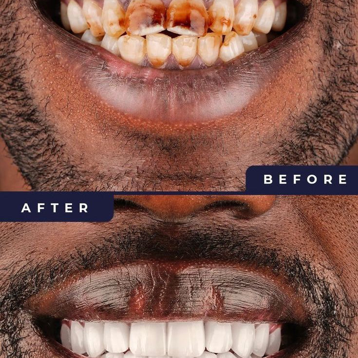 Original dentifrice blanchiment dentaire