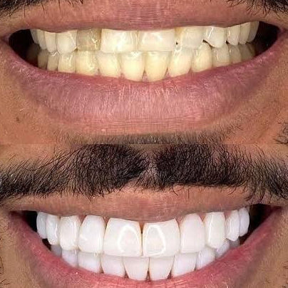 The benefits that make the Original dentifrice BodyAccel blanchiment dentaire & soin complet easier to choose—and easier to stick with   ]